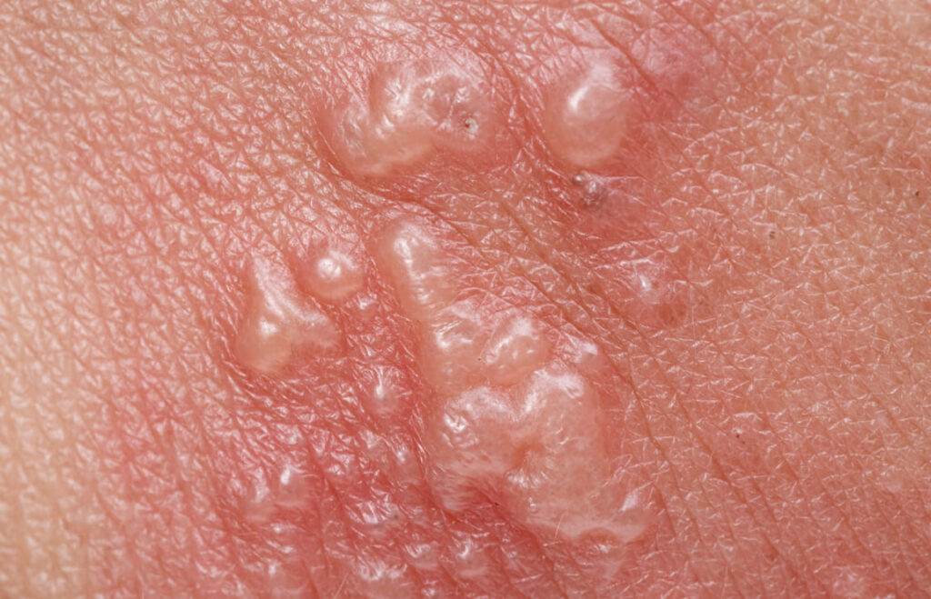 O que é herpes zoster?