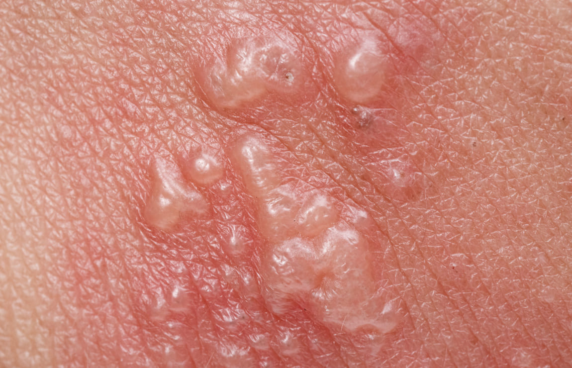 O que é herpes zoster?